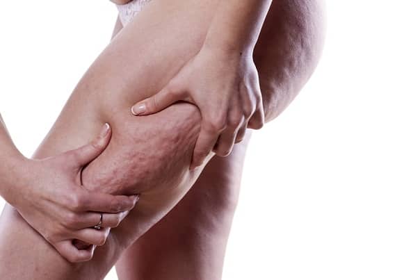 8 astuces naturelles pour réduire efficacement la cellulite